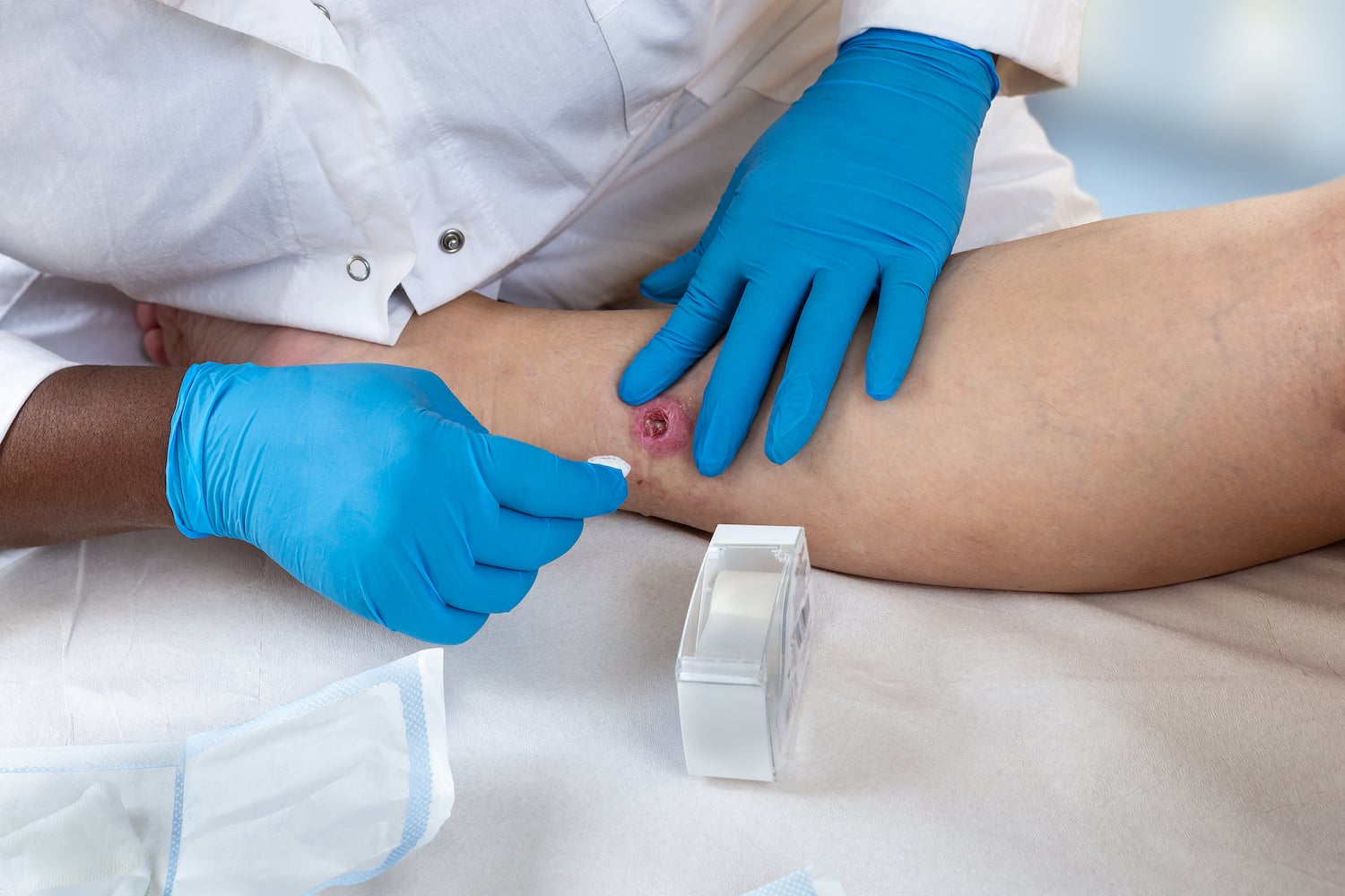 Maladie de Verneuil : la résistance médicale s'organise
